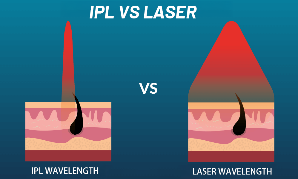 LASER IPL HAIR REMOVAL